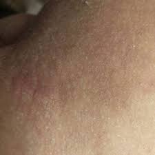 Pickel an der schamlippe können sehr unangenehm sein und verschiedene ursachen haben. Knubbel Zwischen Bein Und Geschlechtsorgan Gesundheit Und Medizin Juckreiz Hautausschlag