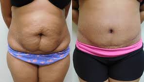 360 tummy tuck s recovery before and after. Mini Tuck And Tummy Tuck Before After Photos Rottman Plastic Surgery