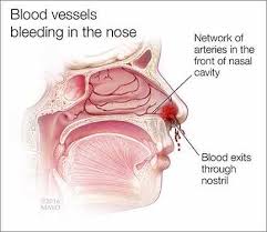 What Causes The Nose To Bleed 4 Easy Steps To Stop The Bleeding Stop Nose Bleeds First Aid Classes Saline Nasal Spray