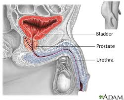 If cancer is suspected, a biopsy of the prostate may be needed. Prostate Cancer Information Mount Sinai New York