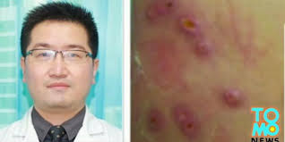 Ciri ciri terkena lalat botfly. Gatal Tak Tertahan Ternyata Tubuh Pria Ini Dipenuhi Belatung Dream Co Id