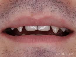 Din aceasta cauza, un vis in care iti cad dintii poate semnifica am simtit un curent puternitc apoi o durere mare in gura. Cat Costa Fatetele Dentare Dr Durbac Dentist In Bucuresti