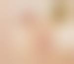 Image result for Bartholin's gland abscess