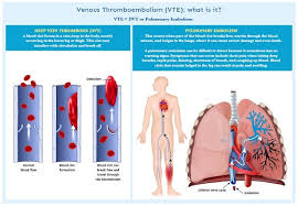 A man coughed up a large blood clot that was in the shape of his bronchial tree, or the lung's branched airway passages. Prevention Is Better Than Cure Singhealth