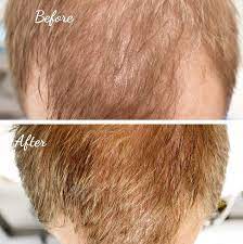 Scientists consider vampire hair therapy the most effective treatment for male and female pattern baldness, apart from surgery. Platelet Rich Plasma Prp Marietta Facial Plastic Surgery