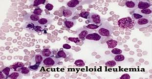Overlooking them as common illnesses can prove to be very costly. Acute Myeloid Leukemia Causes Symptoms And Treatment Assignment Point