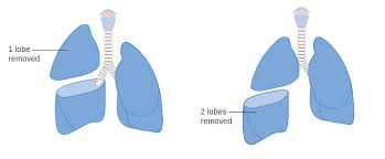 Surgery may be done on tumors that are small and have not spread to other parts of the body. Lobectomy American Lung Association
