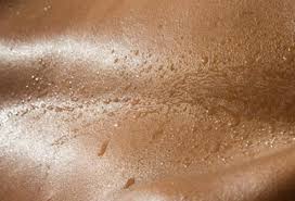 Learn how to treat and get rid of hives with hives naturally. Heat Rash Pictures Symptoms Causes Treatments