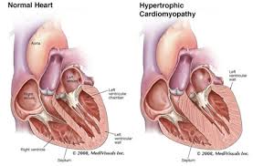 Image result for Cardiomyopathy