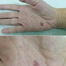 Pdf Caso Atipico De Herpes Zoster Recorrente Em Paciente Imunocompetente Abordagem Diagnostico E Tratamento