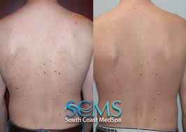 For many men, hair removal habits start and finish with a morning shave, and that suits them just fine. Laser Hair Removal For Women Los Angeles Orange County Virtually Pain Free