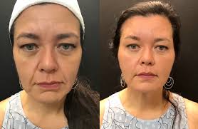 Cheek fillers botox fillers dermal fillers pretty hurts pretty face hair health and beauty beauty inside skin treatments plastic surgery. Juvederm Dermal Fillers Derma Spa Inc