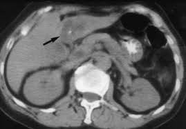 Pt iemoto / bang gunz banggunz twitter. Biliary Cystadenocarcinoma Of The Liver The Need For Complete Resection European Journal Of Cancer