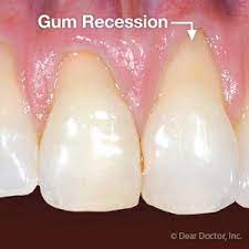 Don T Let Periodontal Disease Cause Your Gums To Recede Magnum Opus Dental