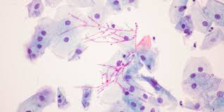 Etter ca 2 uker ømhet i tungen og opphovnet papiller på tungen. Soppinfeksjon I Underlivet Candida Lommelegen