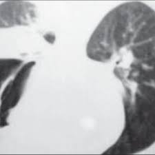 La mucormicosis, una ifi por hongos del orden mucorales (géneros absidia, rhizopus y mucor), supone la tercera causa de ifi detrás de aspergillus y candida spp.1. Pdf Mucormicosis Pulmonar
