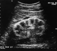 Kidney Renal Cortical Nephrocalcinosis Significant Increase In Cortical Echogenicity Less C Ultrasound Sonography Medical Ultrasound Ultrasound Technician