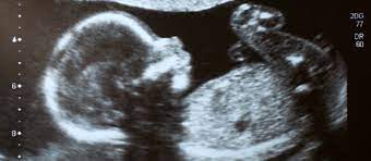 What Causes Fasd Overview Of Fetal Alcohol Spectrum Disorders Fasd