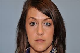 Rhinoplasty Before and After Photos by Paul Vanek, MD, FACS; Concord, OH