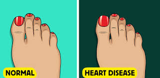 Image result for Clubbing nails feet