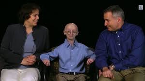 Sam burns age & date of birth: Rest In Peace Sam Berns The Real Life Benjamin Button Dies At 17 Video Ibtimes India