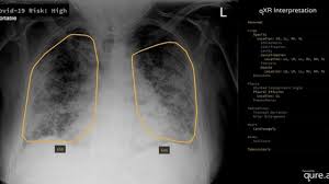 Check spelling or type a new query. Virus Corona Terobosan Baru Memeriksa Paru Paru Pasien Covid 19 Dengan Kecerdasan Buatan Bbc News Indonesia