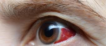 Image result for Acute Red Eye
