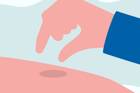 Cool water dissipates the heat from the friction, and prevents the burn from worsening. How To Treat Burns Scalds At Home Full Guide Savlon