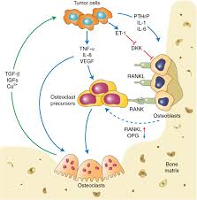 Ewing tumors (ewing sarcomas) are the second most . Molecular Mechanisms And Clinical Management Of Cancer Bone Metastasis Bone Research