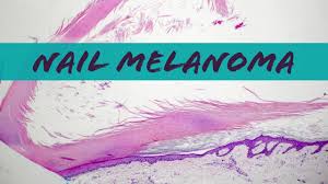 Image result for Acral lentiginous melanoma nail