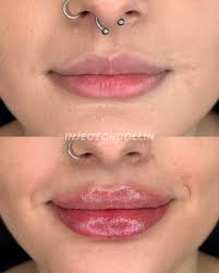 A syringe of Kysse for a more balanced and symmetric pout 💋💄✨