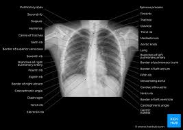 A=aorta, aer=azygoesophageal recess, ajl=anterior junction line postprandial the most likely cause is physiological and due to inadequate preparation. Radiological Anatomy X Ray Ct Mri Kenhub