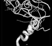 Image result for what are the causes and treatment for aneurysm"