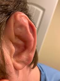 Why did we find out so late? Cauliflower Ear Wikipedia