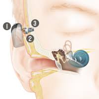 (baha), type of hearing aid based on bone conduction. Horimplantate Cochlear Baha Connect System Cochlear Switzerland