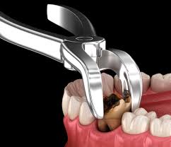 Image result for Tooth Extraction