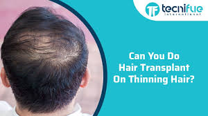 Hair loss, on the other hand, is when something happens that actually stops your hair from growing, the aad explains. Can You Do Hair Transplant On Thinning Hair Tecnifue Best Hair Transplant