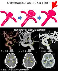 비탄의 망령은 은퇴하고싶다 1권 선탈주. è„³å‹•è„ˆç˜¤ å¯¾è±¡ç–¾æ‚£ åŒ»ç™‚é–¢ä¿‚è€…ã¸ è¿'ç•¿å¤§å­¦åŒ»å­¦éƒ¨ è„³ç¥žçµŒå¤–ç§'