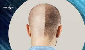 زراعة الشعر باستخدام الخلايا الجذعية Infinity Hair Wearable Fitbit