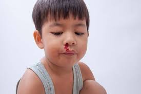Hidung berdarah atau lebih dikenali dengan nama 'epistaxis' kemungkinan terjadi berikutan komplikasi kecederaan saluran darah dalam hidung. Hidung Anak Berdarah Buat Ibu Tercari Cari Punca Salah Satunya Kerap Guna Ubat Nasal Spray Pa Ma