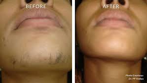 They cost $100 and have a lifespan of 15 years! Laser Hair Removal Face Cost Off 62 Online Shopping Site For Fashion Lifestyle
