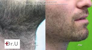 Depending on the patient's skin, the procedure can take between 2 to 5 hours. Body To Beard Hair Transplant For A Better Match In Color And Texture