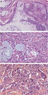 Final pathology revealed high grade mucoepidermoid carcinoma arising from a pleomorphic adenoma. Genomic Profiles And Crtc1 Maml2 Fusion Distinguish Different Subtypes Of Mucoepidermoid Carcinoma Modern Pathology