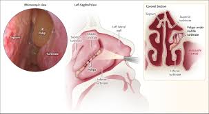 Image result for Rhinosinusitis