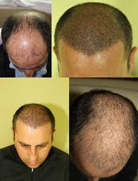 Or are there examples which some guys had a significant transform after 9 months. 7 Factors That Reduce Shock Loss Dr Hakan Doganay