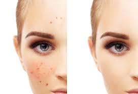 The best products for healing and preventing hyperpigmentation according to experts including pca intensive brightening treatment, cerave ultra light every dermatologist we spoke to stressed the importance of protecting the skin from uv light with sunscreen, whether you're treating spots or. 10 Working Home Remedies For Skin Pigmentation
