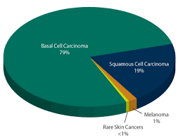 Also called carcinoma in situ, cancer discovered in this stage is only present in the epidermis (upper layer of the skin) and has not spread deeper to the dermis. Skin Cancer Radiation Therapy Treatment In Charlotte Sero