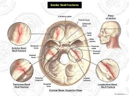 Basilar Skull Fracture With Anterior Transverse And Longitudinal Basilar Skull Fractures Leaves M Medical Art Nursing Study Guide Medical Illustration