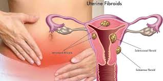 We did not find results for: Fibrome Uterin Symptomes Causes Operation Directactu