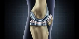 See full list on practicalpainmanagement.com How Long Does Pain Last After Knee Replacement Surgery Arizona Pain